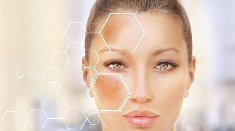 Dark,Spots,,Freckles,hyperpigmentation(melasma,Or,Chloasma) Dark,Spots,,Freckles,hyperpigmentation(melasma,Or,Chloasma)